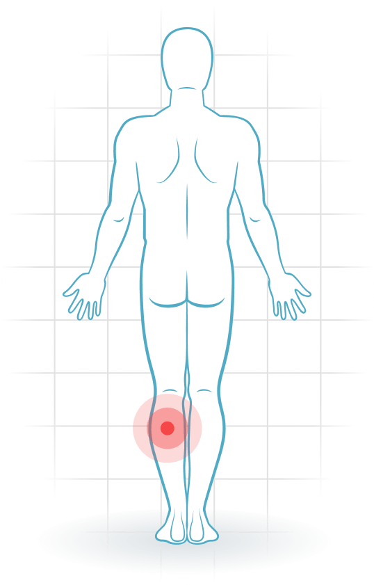 pijnlocatie Compartment syndrome of the lower leg