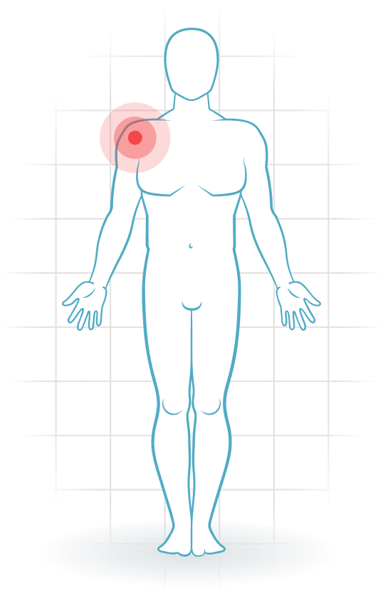 pijnlocatie Impingement syndrome