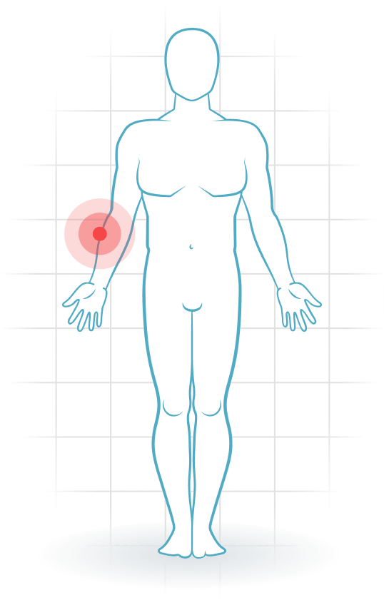 pijnlocatie Radial tunnel syndrome