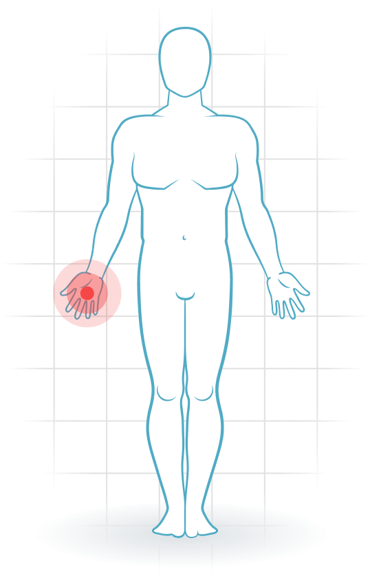 pijnlocatie Osteoarthritis of the hand