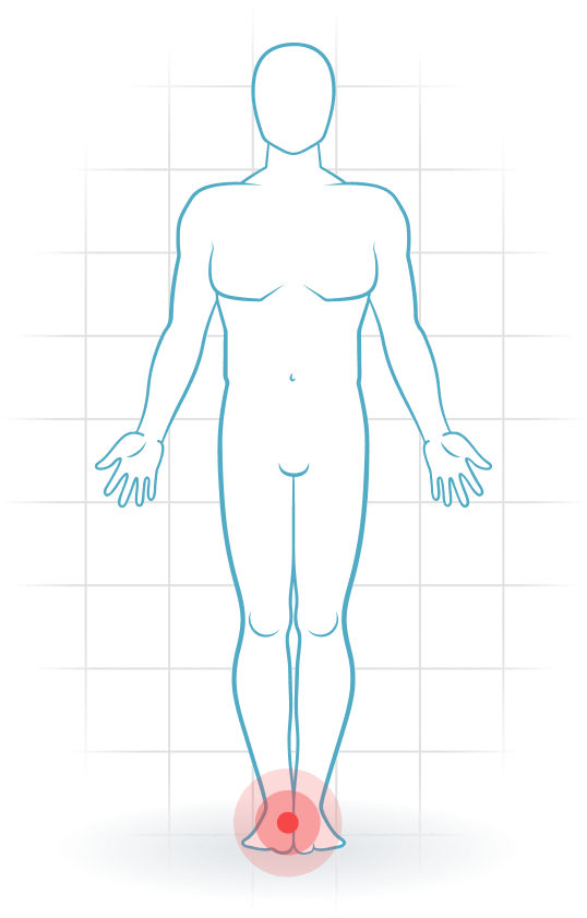 pijnlocatie Tarsal tunnel syndrome